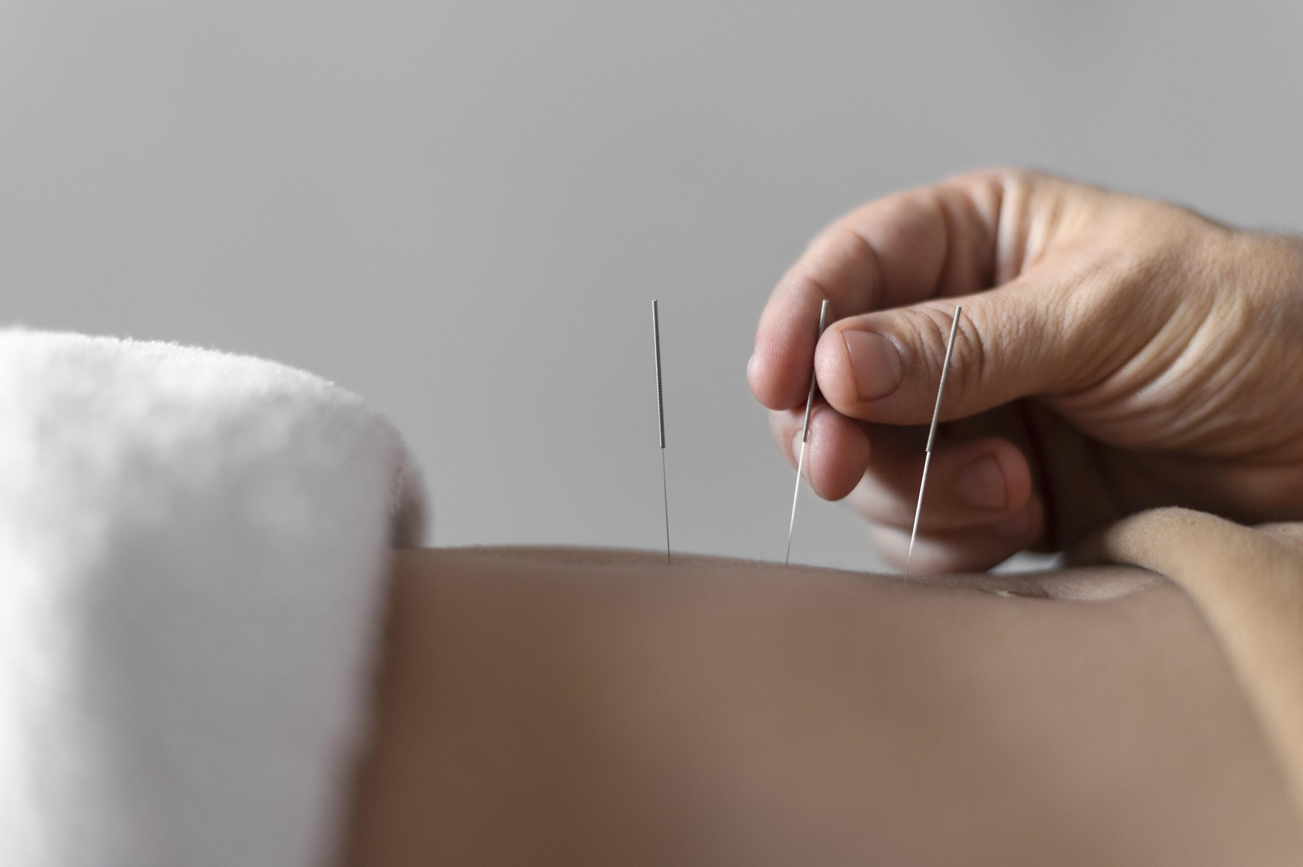 ACUPUNCTURE